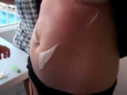 Peel » Ibiza Sun Burn Skin Peel